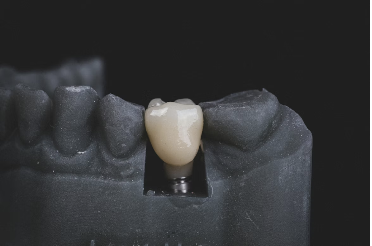 Benefits of Dental Implants and Their Trusted Role in Restoration